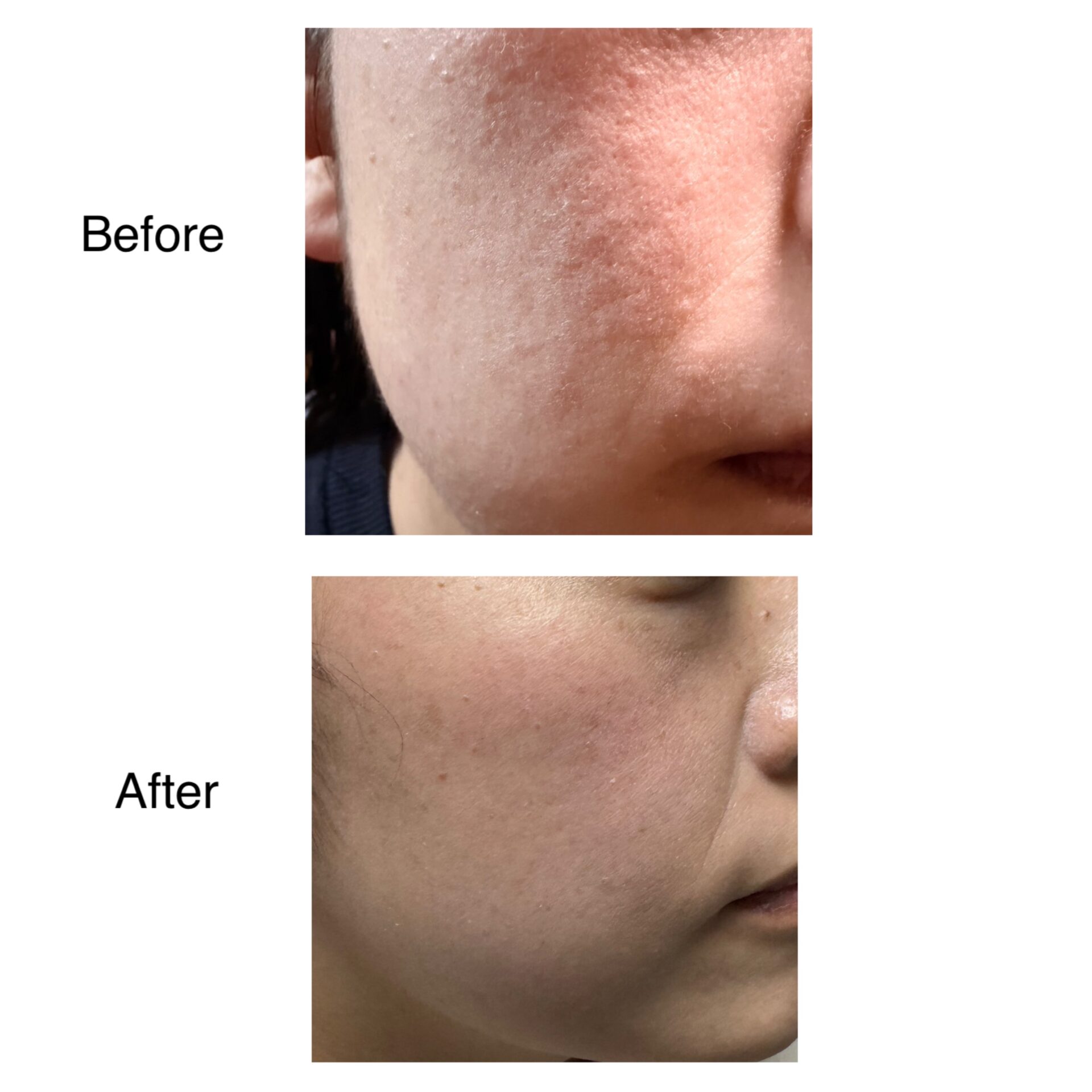 肌質改善コース